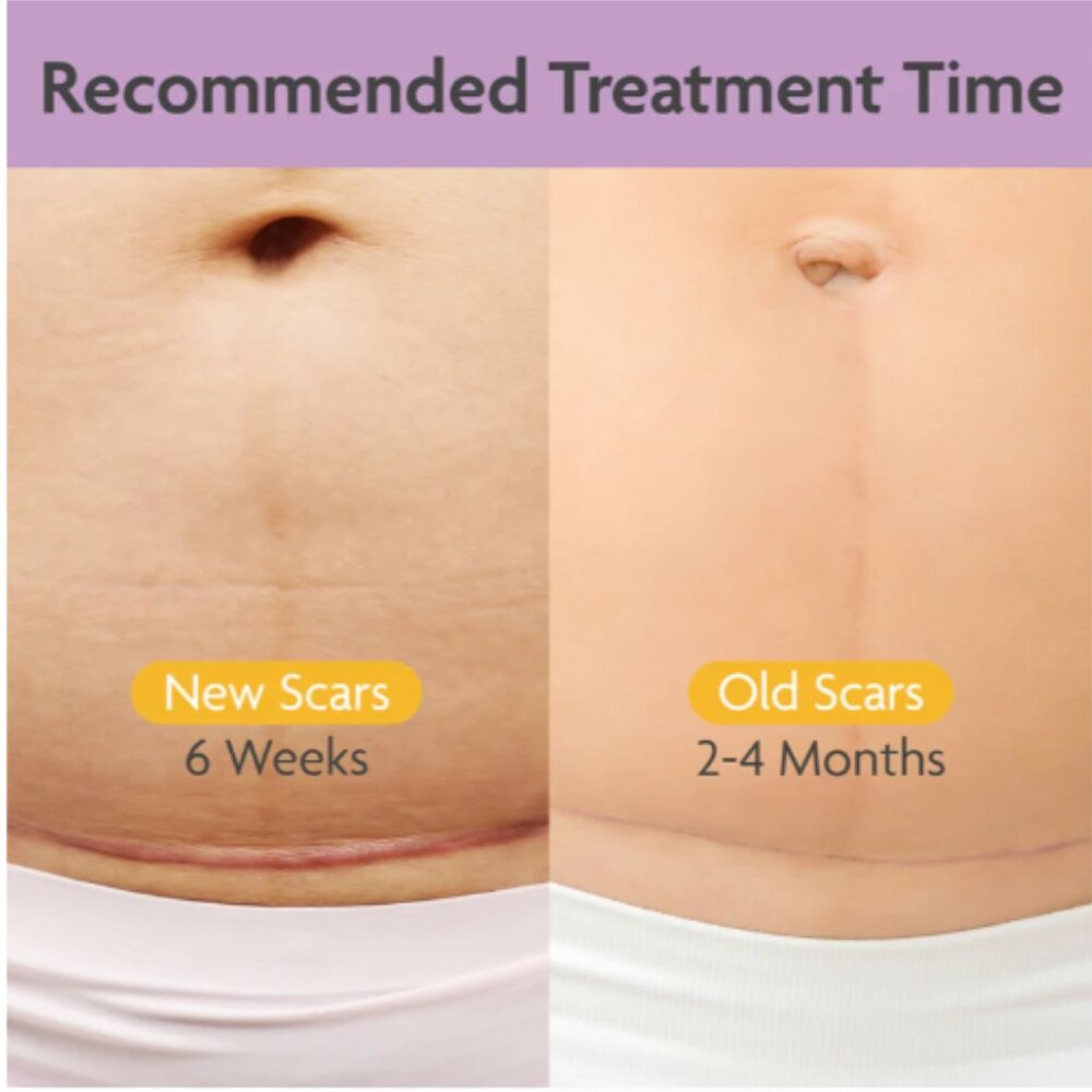 TriLASTIN C-Section Scar Sheet - Anchor - Picture 4 of 4